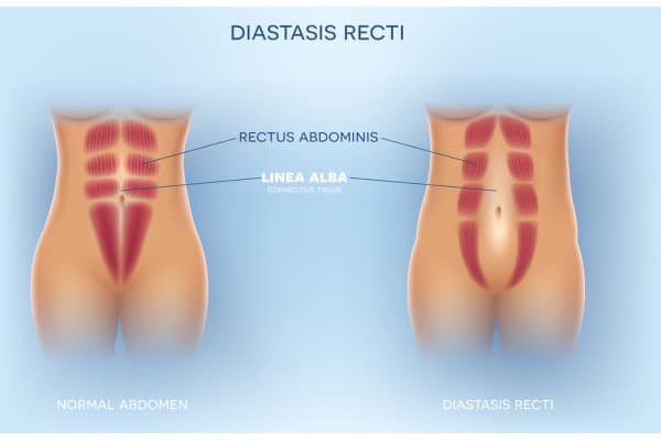 What Non-Surgical Options Are Available for Diastasis Recti Cheadle?