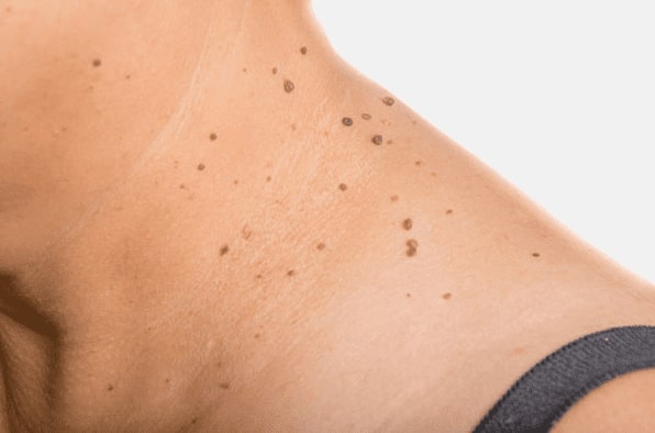 Are you looking for easy skin tag removal Cheadle - then contact Spire today!
