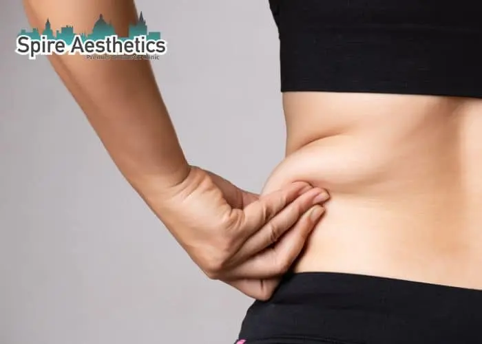 Image of woman pinching fat on their hips Cheadle. Fat Freezing treatment