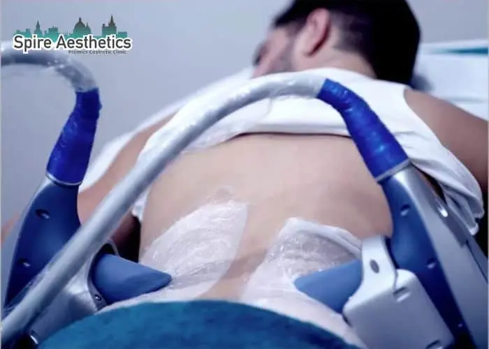 Man having fat freezing treatment done on love handles before a competitions Cheadle to create a sculpted look.