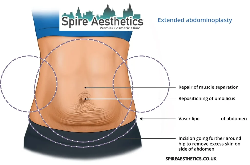 Understanding Loose Skin After Gastric Band Cheadle Surgery and HIFU Treatment