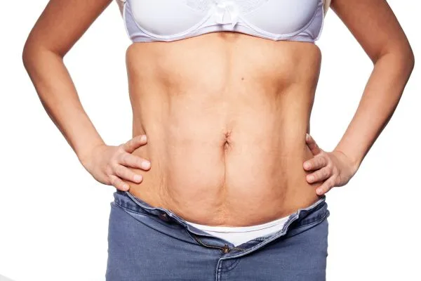 sagging skin on woman's stomach after weight loss injections Cheadle