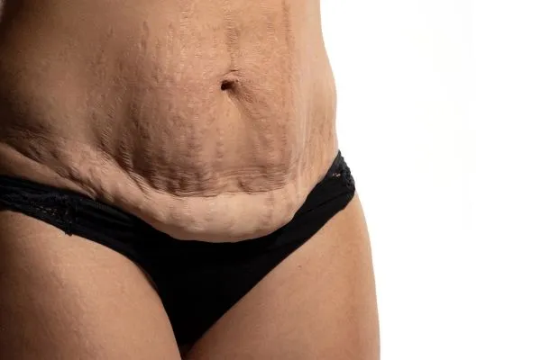 Image of womans stomach after weight loss injections Cheadle showing saggy skin